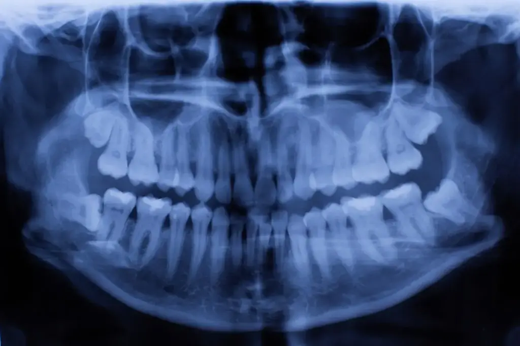 Fogröntgen, digitális röntgen Dombi Dentál
